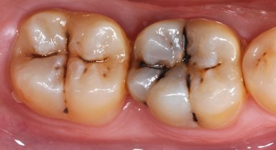 مقاله کربو هیدارت ها و پوسیدگی دندان
