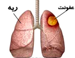 دانلود مقاله تشخیص عفونت های حاد دستگاه تنفس تحتانی